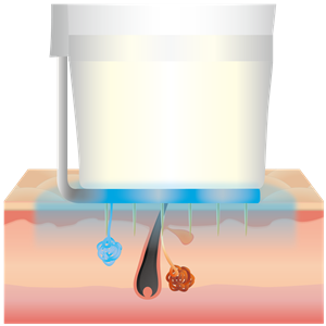 最新ビューホット治療